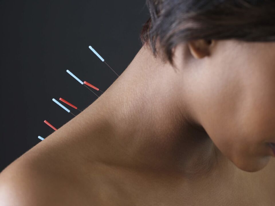 Acupuncture in cervical osteochondrosis removes inflammatory processes