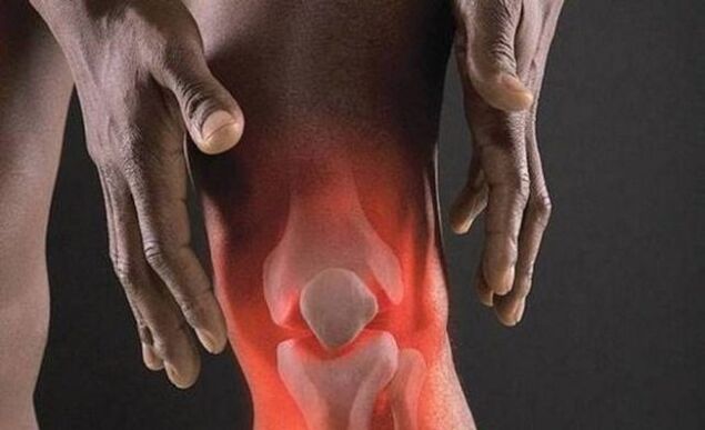Arthrosis is accompanied by an inflammatory process in the knee joint